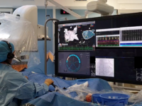 Une ablation par IA avec le logiciel VX1 de Volta Medical