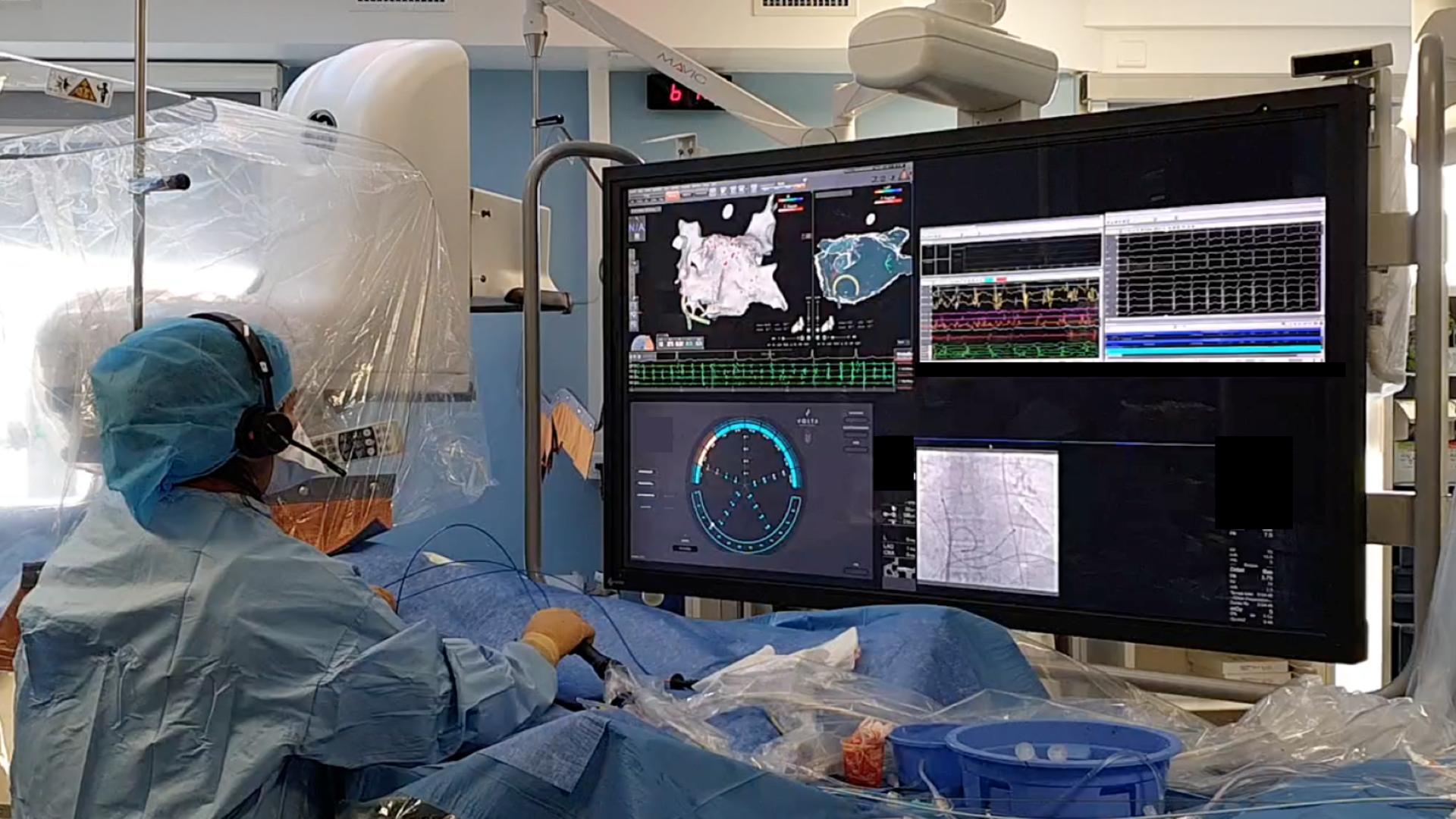 Une ablation par IA avec le logiciel VX1 de Volta Medical