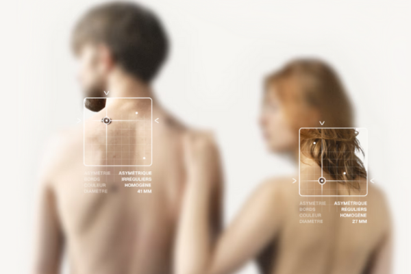 Image à la une de l'article DermaScan lève 2,5 M€ pour mieux dépister les cancers de la peau